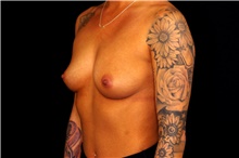 Breast Augmentation Before Photo by Landon Pryor, MD, FACS; Rockford, IL - Case 45139