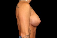 Breast Augmentation After Photo by Landon Pryor, MD, FACS; Rockford, IL - Case 45139