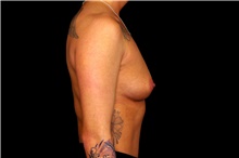 Breast Augmentation Before Photo by Landon Pryor, MD, FACS; Rockford, IL - Case 45139