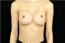 Breast Augmentation After Photo by Landon Pryor, MD, FACS; Rockford, IL - Case 45141