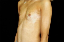 Breast Augmentation Before Photo by Landon Pryor, MD, FACS; Rockford, IL - Case 45141