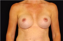 Breast Augmentation After Photo by Landon Pryor, MD, FACS; Rockford, IL - Case 45142