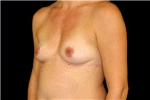 Breast Augmentation Before Photo by Landon Pryor, MD, FACS; Rockford, IL - Case 45142