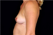 Breast Augmentation Before Photo by Landon Pryor, MD, FACS; Rockford, IL - Case 45142