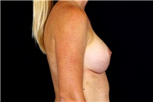 Breast Augmentation After Photo by Landon Pryor, MD, FACS; Rockford, IL - Case 45142