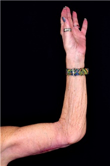 Arm Lift Before Photo by Landon Pryor, MD, FACS; Rockford, IL - Case 45143