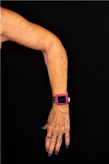 Arm Lift Before Photo by Landon Pryor, MD, FACS; Rockford, IL - Case 45143
