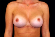 Breast Augmentation After Photo by Landon Pryor, MD, FACS; Rockford, IL - Case 45148