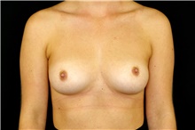 Breast Augmentation Before Photo by Landon Pryor, MD, FACS; Rockford, IL - Case 45148