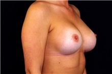 Breast Augmentation After Photo by Landon Pryor, MD, FACS; Rockford, IL - Case 45148