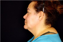 Facelift Before Photo by Landon Pryor, MD, FACS; Rockford, IL - Case 45149
