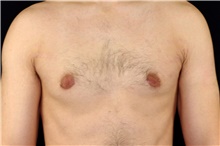 Male Breast Reduction After Photo by Landon Pryor, MD, FACS; Rockford, IL - Case 45150