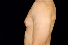 Male Breast Reduction Before Photo by Landon Pryor, MD, FACS; Rockford, IL - Case 45150