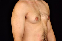 Male Breast Reduction Before Photo by Landon Pryor, MD, FACS; Rockford, IL - Case 45150