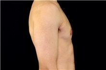 Male Breast Reduction After Photo by Landon Pryor, MD, FACS; Rockford, IL - Case 45150