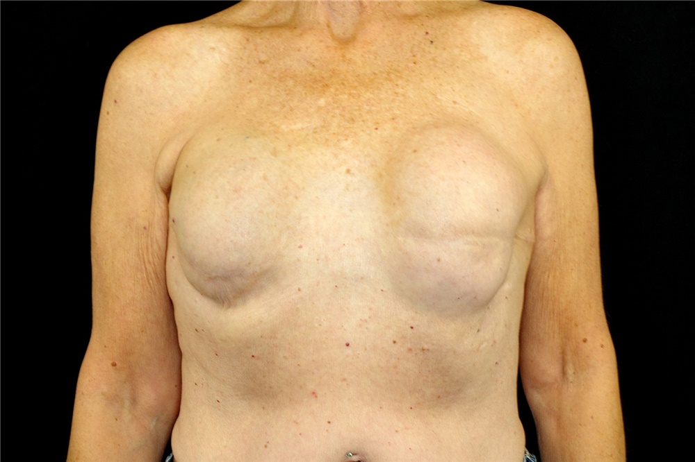 Breast Implant Removal Before and After Photos by Landon Pryor, MD, FACS;  Rockford, IL - Case 45152