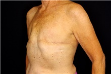 Breast Implant Removal After Photo by Landon Pryor, MD, FACS; Rockford, IL - Case 45152