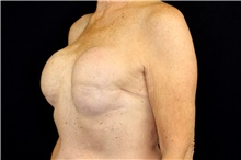 Breast Implant Removal Before Photo by Landon Pryor, MD, FACS; Rockford, IL - Case 45152