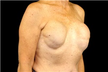 Breast Implant Removal Before Photo by Landon Pryor, MD, FACS; Rockford, IL - Case 45152