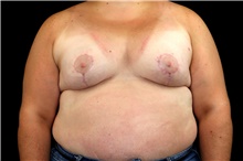 Breast Augmentation After Photo by Landon Pryor, MD, FACS; Rockford, IL - Case 45154