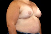 Breast Augmentation After Photo by Landon Pryor, MD, FACS; Rockford, IL - Case 45154