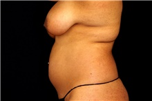 Tummy Tuck Before Photo by Landon Pryor, MD, FACS; Rockford, IL - Case 45155
