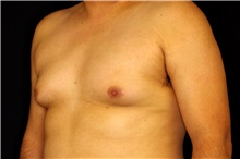 Male Breast Reduction Before Photo by Landon Pryor, MD, FACS; Rockford, IL - Case 45156