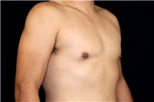 Male Breast Reduction After Photo by Landon Pryor, MD, FACS; Rockford, IL - Case 45156