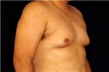 Male Breast Reduction Before Photo by Landon Pryor, MD, FACS; Rockford, IL - Case 45156