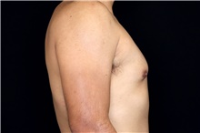 Male Breast Reduction After Photo by Landon Pryor, MD, FACS; Rockford, IL - Case 45156