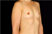Breast Augmentation Before Photo by Landon Pryor, MD, FACS; Rockford, IL - Case 45157
