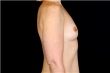Breast Augmentation Before Photo by Landon Pryor, MD, FACS; Rockford, IL - Case 45157