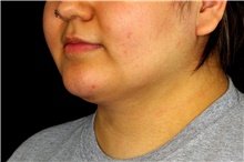 Liposuction After Photo by Landon Pryor, MD, FACS; Rockford, IL - Case 45158
