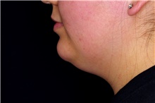 Liposuction Before Photo by Landon Pryor, MD, FACS; Rockford, IL - Case 45158