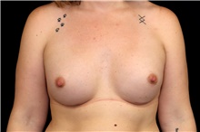 Breast Augmentation After Photo by Landon Pryor, MD, FACS; Rockford, IL - Case 45159