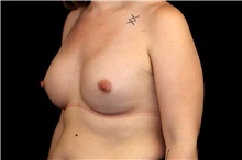 Breast Augmentation After Photo by Landon Pryor, MD, FACS; Rockford, IL - Case 45159