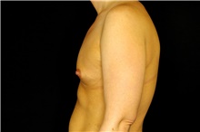 Breast Augmentation Before Photo by Landon Pryor, MD, FACS; Rockford, IL - Case 45159