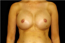 Breast Augmentation After Photo by Landon Pryor, MD, FACS; Rockford, IL - Case 45161