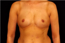 Breast Augmentation Before Photo by Landon Pryor, MD, FACS; Rockford, IL - Case 45161
