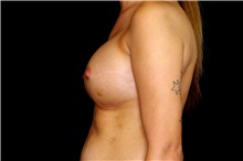 Breast Augmentation After Photo by Landon Pryor, MD, FACS; Rockford, IL - Case 45161