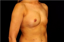 Breast Augmentation Before Photo by Landon Pryor, MD, FACS; Rockford, IL - Case 45161