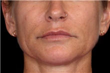 Injectable Fillers After Photo by Landon Pryor, MD, FACS; Rockford, IL - Case 45162