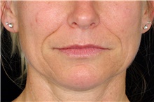 Injectable Fillers Before Photo by Landon Pryor, MD, FACS; Rockford, IL - Case 45162