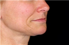 Injectable Fillers Before Photo by Landon Pryor, MD, FACS; Rockford, IL - Case 45162