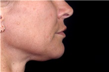 Injectable Fillers After Photo by Landon Pryor, MD, FACS; Rockford, IL - Case 45162