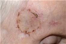 Head and Neck Skin Cancer Reconstruction After Photo by Landon Pryor, MD, FACS; Rockford, IL - Case 45163