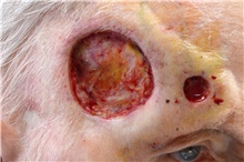 Head and Neck Skin Cancer Reconstruction Before Photo by Landon Pryor, MD, FACS; Rockford, IL - Case 45163