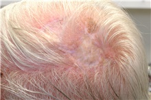 Head and Neck Skin Cancer Reconstruction After Photo by Landon Pryor, MD, FACS; Rockford, IL - Case 45164