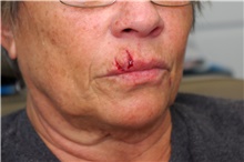Scar Revision Before Photo by Landon Pryor, MD, FACS; Rockford, IL - Case 45165