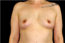 Breast Augmentation Before Photo by Landon Pryor, MD, FACS; Rockford, IL - Case 45166